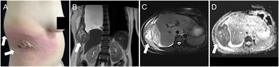 Case Report: Lung Adenocarcinoma Initially Presenting With Cutaneous and Subcutaneous Metastases